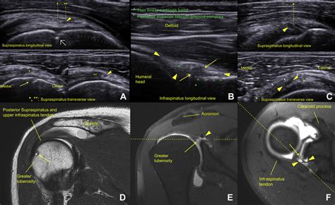 Supraspinatus Tendon Mri