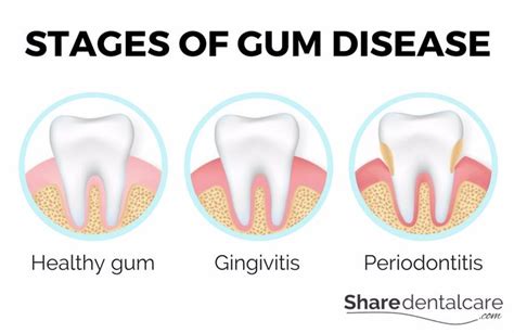 Gum Disease: Causes, Treatment, and Prevention | Share Dental Care