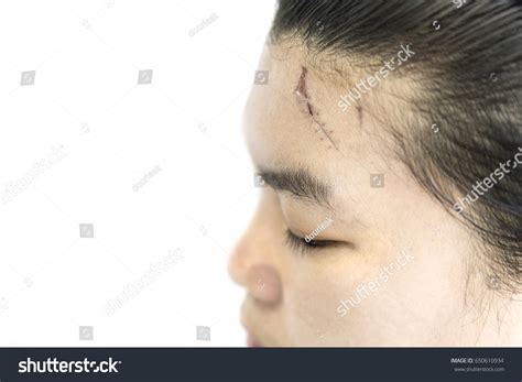 Scar On Forehead Injured Person Stock Photo 650610934 | Shutterstock