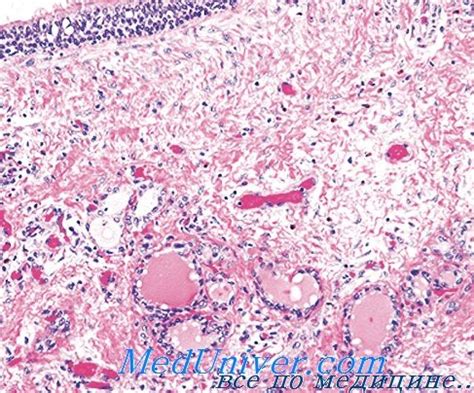 Median Palatal Cyst Histology