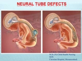 Neural Tube Defects (NTDs): What They Are, Causes, 45% OFF