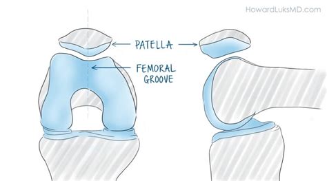 The Dislocated Patella or Kneecap: It Is More Common Than You Think