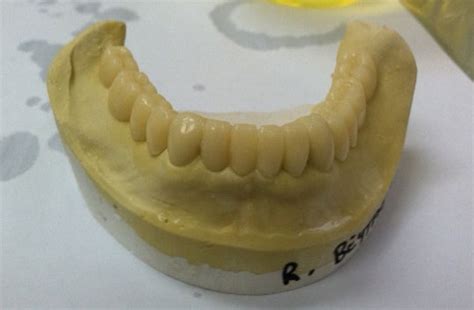 Acetal Resin Overpartials Fabrications in Atlanta GA | Snap-On Smile