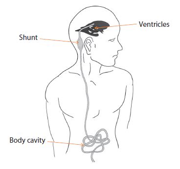 Adult Hydrocephalus - Conditions & Treatments | SingHealth