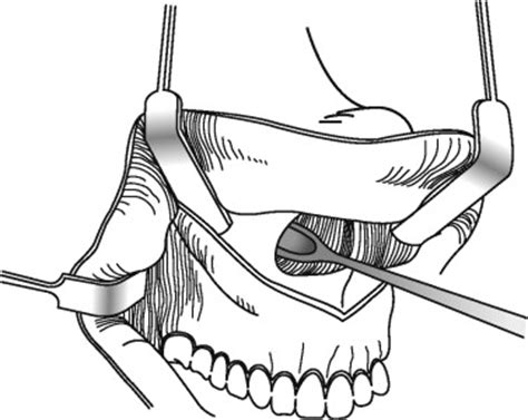 MAXILLARY OSTEOTOMIES: LE FORT I OSTEOTOMY | Pocket Dentistry