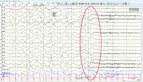 Electroencephalography (EEG) showed generalized slowing and multifocal... | Download Scientific ...