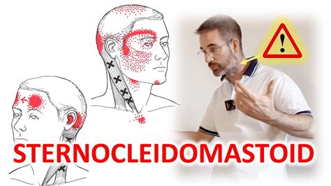 Sternocleidomastoid Muscle Pain