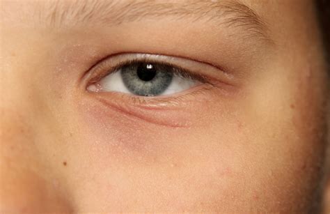 What are the common causes of Eyelid Eczema - Health Works Collective