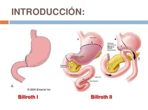 difference between billroth i and billroth ii - Google Search Surgery ...