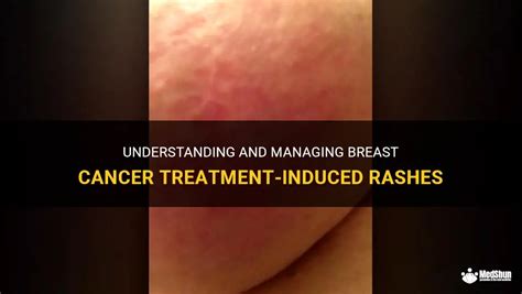 Understanding And Managing Breast Cancer Treatment-Induced Rashes | MedShun