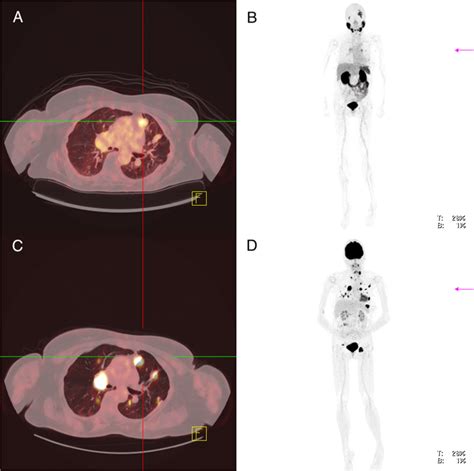 Patient 7: 68 Ga-PSMA-PET/CT (A,B), 18 FDG-PET/CT (C,D). Inhomogeneous ...