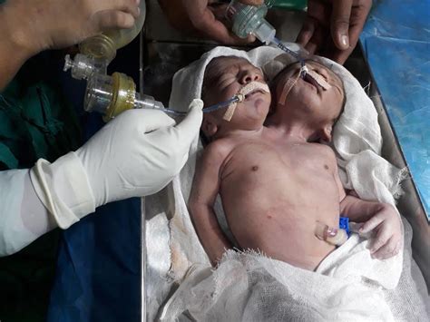 'One-in-a-million' conjoined twins with two heads and same torso born in India | The Independent ...