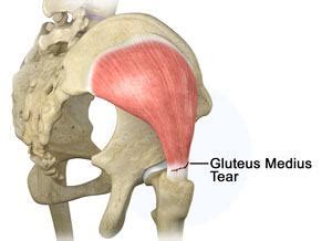 Gluteus Tendon Tear Henderson | Gluteus Tendon Repair Boulder City NV