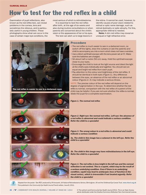 How To Test For The Red Reflex in A Child | PDF | Eye | Retina