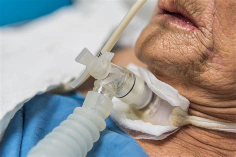 Tracheostomy During COVID-19: CHEST/AABIP/AIPPD Recommendations - Pulmonology Advisor