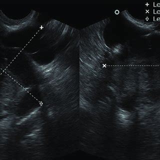 Pelvis ultrasound with left adnexal mass with echogenic solid component ...