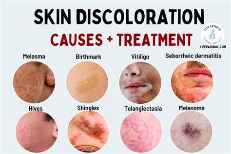 Skin Discoloration: Causes, Pictures, and Treatment