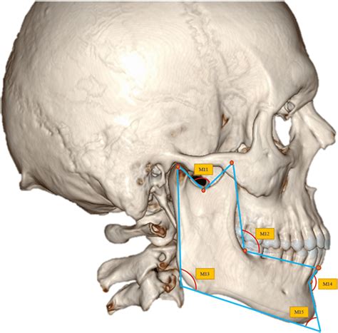 Angular parameters on mandible (right side view). M11, angle of... | Download Scientific Diagram