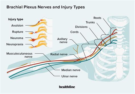 Everything you need to know about brachial plexus injuries – Artofit