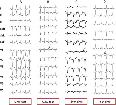 Different types of AVNRT ECG presentation. In all types, the P wave is relatively narrow, - in ...