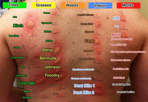 Allergy testing for #mold - | Allergy remedies, Dust allergy, Dust mite ...