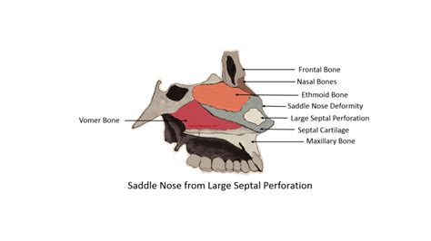 Septal Perforation Repair - Dr. Jonathan Harounian