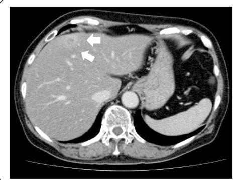 CT scan findings. CT scan revealed a 10-mm space-occupying lesion in...