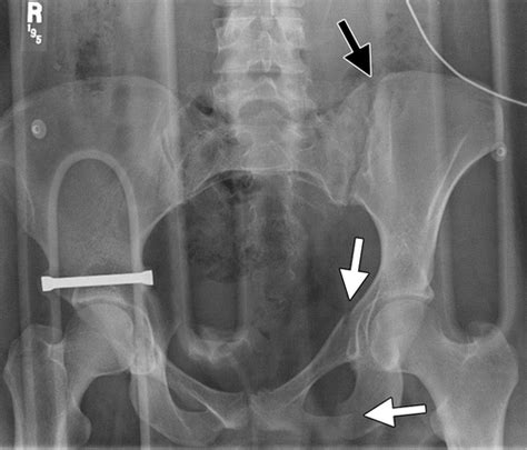 Pelvic Fracture X Ray