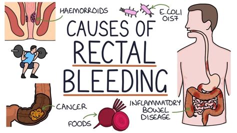 Understanding Anal Bleeding: Causes and Treatment - Ask The Nurse Expert