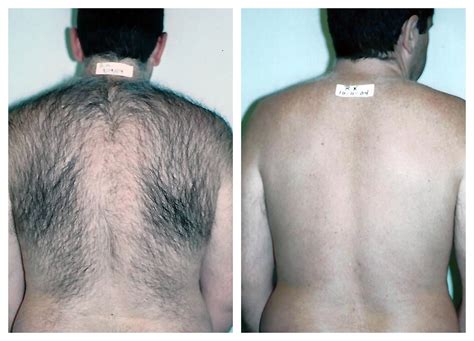 Laser Hair Removal for Men in Pittsburgh - Happel Laser Spa