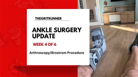 Ankle Arthroscopy/Brostrom Procedure - What to Expect + My Experience - YouTube