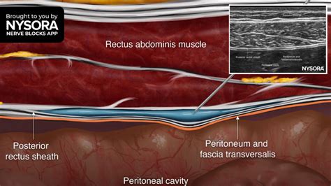 Tips for a Rectus Sheath Block - NYSORA