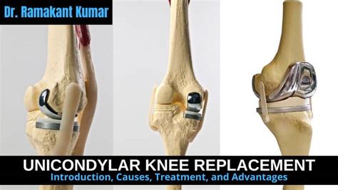 Unicondylar Knee Replacement: Everything You Need to Know