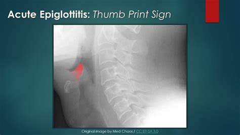 Normal Epiglottis X Ray