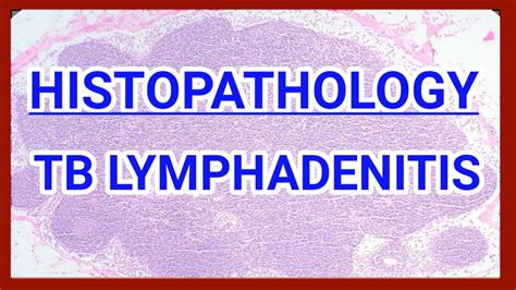 Tuberculous lymphadenitis histopathology | Lymphnode tuberculosis ...