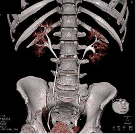 Renal Papillary Necrosis Ring Sign