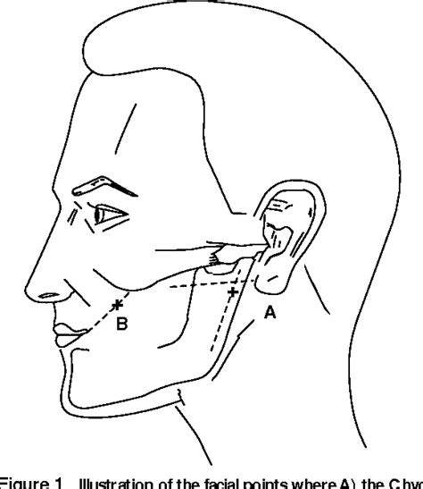 Signs of Hypocalcemia: Chvostek's and Trousseau's Signs | Semantic Scholar