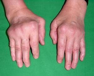 Rheumatoid Arthritis-Hand Surgery-Wrist Surgery-Elbow Surgery