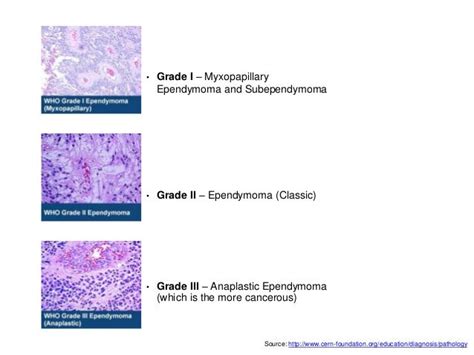 Ependymoma