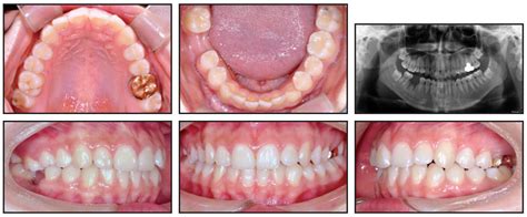 Benefits of Delaying Root Extraction to Accelerate Space Closure