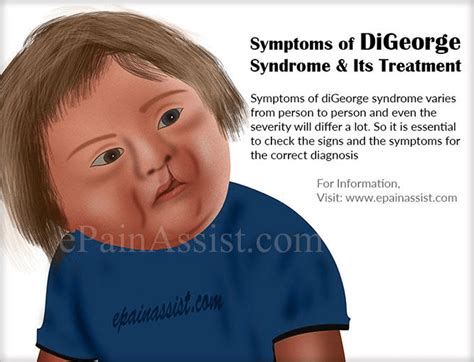 Digeorge Syndrome