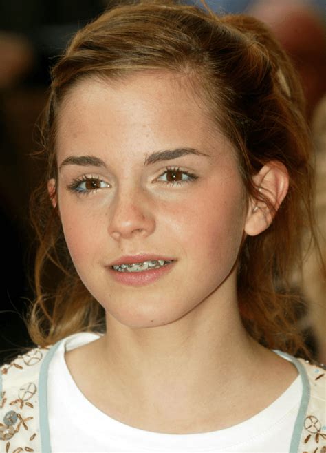 10 Celebrities You Never Knew Had Braces