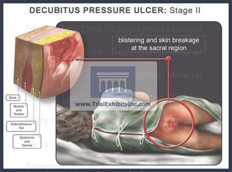 Icd 10 Code For Decubitus Ulcer Of The Sacrum, Stage 3