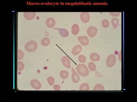 Megaloblastic anemia - презентация онлайн