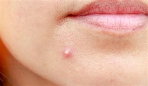 Boil vs. Pimple – Definition, Causes and How to Treat – Tiege Hanley