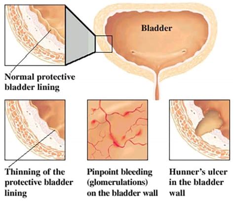 Dr Tim Nathan Urology | Interstitial Cystitis