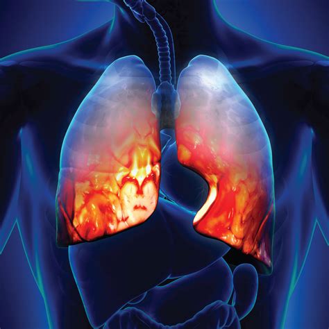 Pneumonitis: A Delayed Reaction