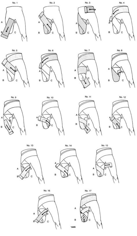 Fig 23-3. Transfemoral residual limb wrapping. | O&P Digital Resource Library