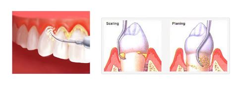 Scaling and Root Planing Midland Park, Wyckoff NJ | Midland Park Family Dentistry