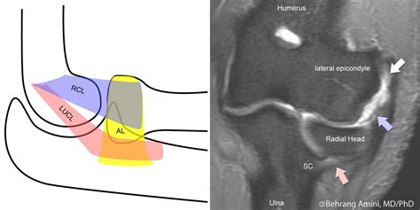 MRI Musculo-Skeletal Section: Radial collateral ligament pathology